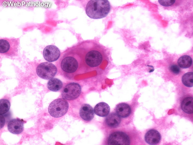 Leydig Cell Tumor - Reinke's Crystalloids3_resized.jpg